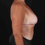 Liposuction Before & After Patient #1440