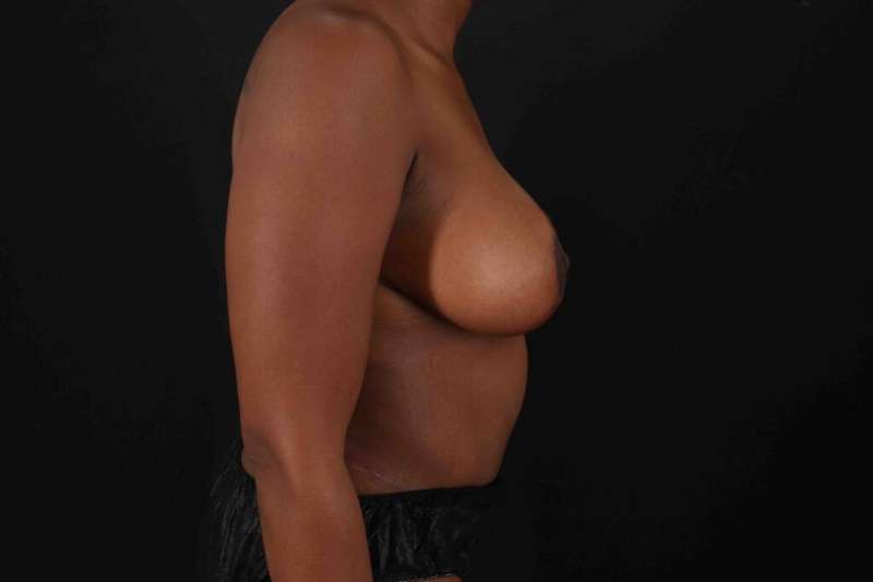 Tummy Tuck Before & After Patient #1451