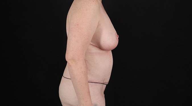 Tummy Tuck Before & After Patient #1477