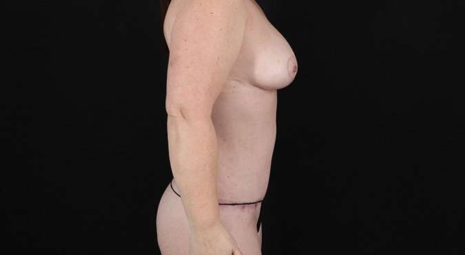 Tummy Tuck Before & After Patient #1504