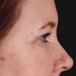 Brow Lift Before & After Patient #1566
