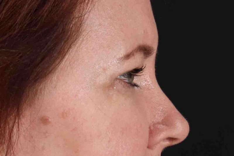 Brow Lift Before & After Patient #1566