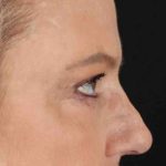 Brow Lift Before & After Patient #1577