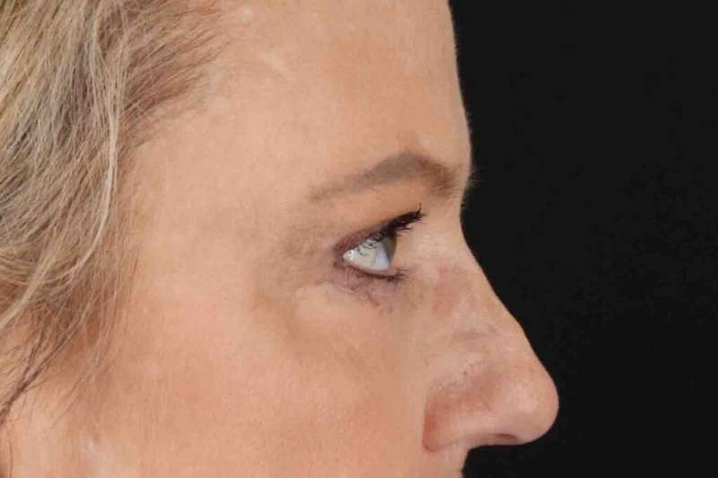 Brow Lift Before & After Patient #1577