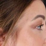 Brow Lift Before & After Patient #1588