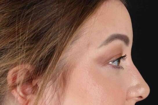 Brow Lift Before & After Patient #1588