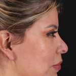 Face Lift Before & After Patient #1643
