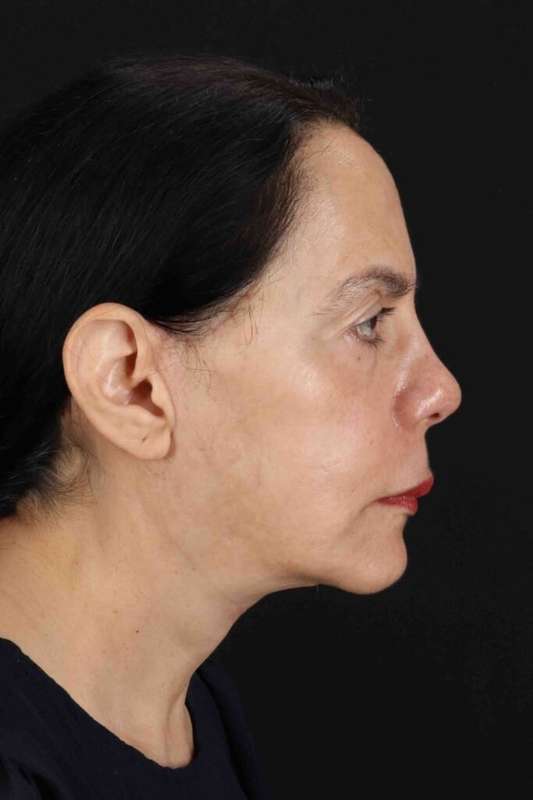 Neck Lift Before & After Patient #1687