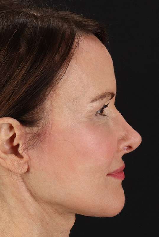Neck Lift Before & After Patient #1698
