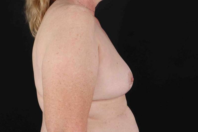 Breast Implant Removal Before & After Patient #872