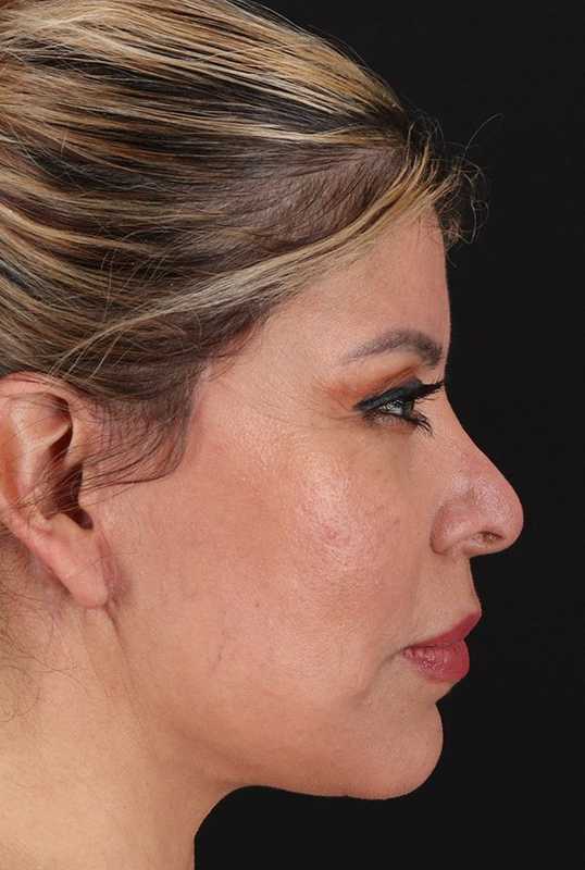 Neck Lift Before & After Patient #1709