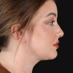 Neck Liposuction Before & After Patient #1742