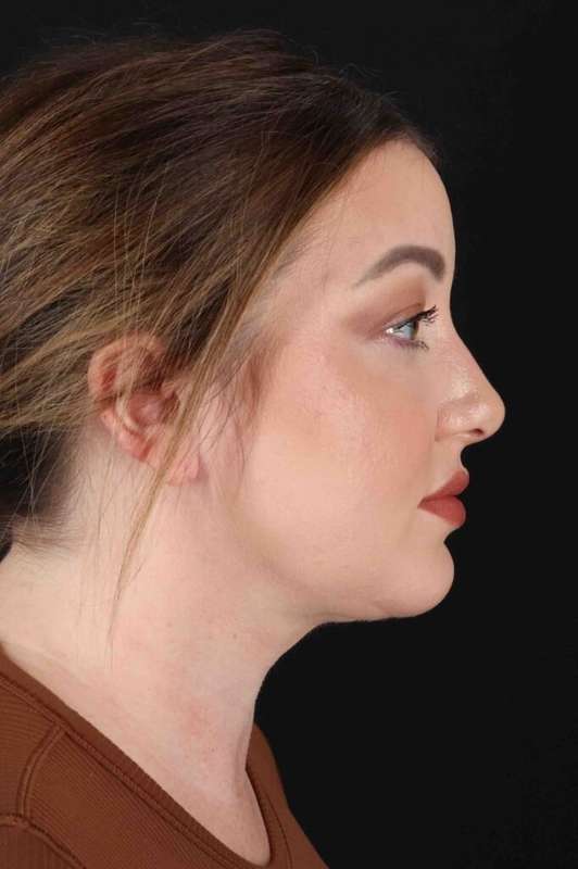 Neck Liposuction Before & After Patient #1742