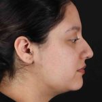 Neck Liposuction Before & After Patient #1753