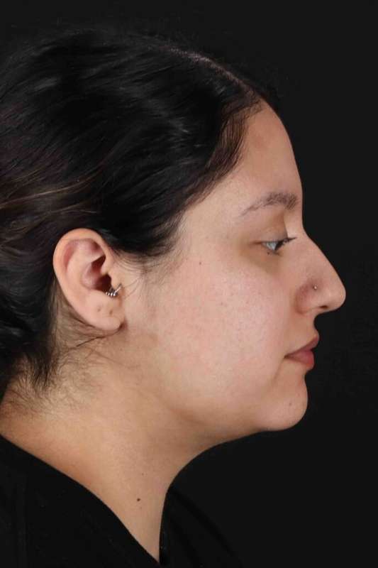 Neck Liposuction Before & After Patient #1753