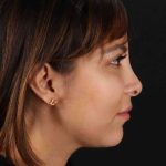 Neck Liposuction Before & After Patient #1764