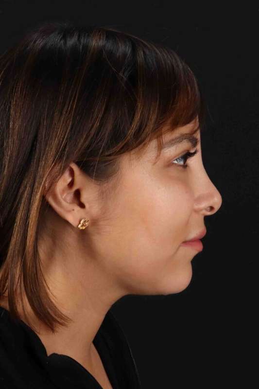 Neck Liposuction Before & After Patient #1764