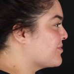 Neck Liposuction Before & After Patient #1775