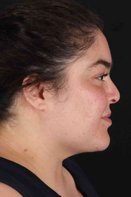 Neck Liposuction Before & After Patient #1775
