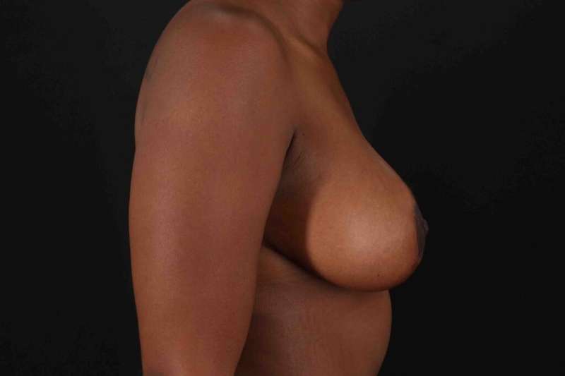 Breast Reduction with Lift Before & After Patient #883