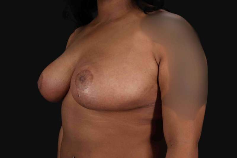 Breast Reduction with Lift Before & After Patient #905