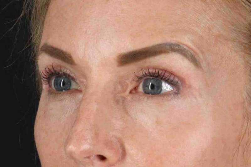 Laser Before & After Patient #2070