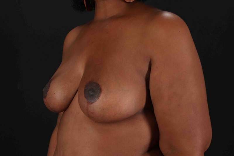 Breast Reduction with Lift Before & After Patient #917
