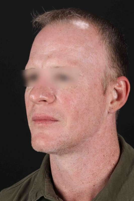 Laser Before & After Patient #2158