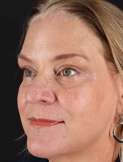 Chemical Peel Before & After Patient #2169