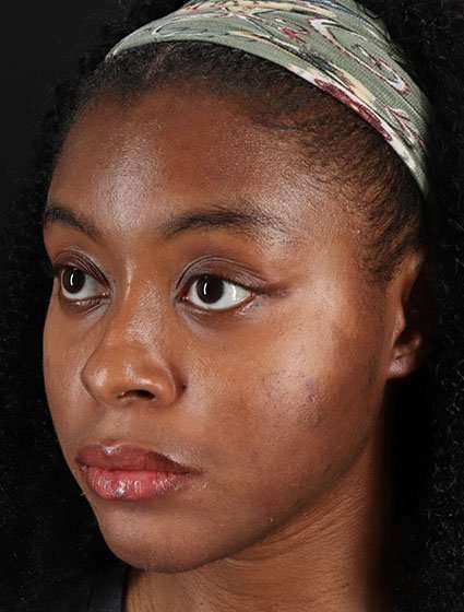 Chemical Peel Before & After Patient #2213