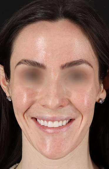Cosmetic Injectables Before & After Patient #2236