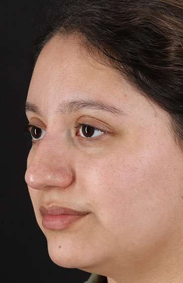 Cosmetic Injectables Before & After Patient #2253