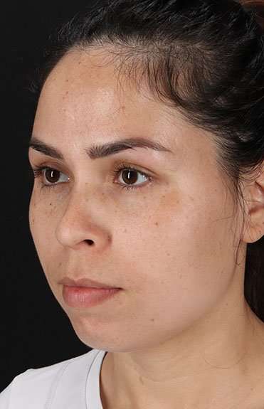 Cosmetic Injectables Before & After Patient #2264
