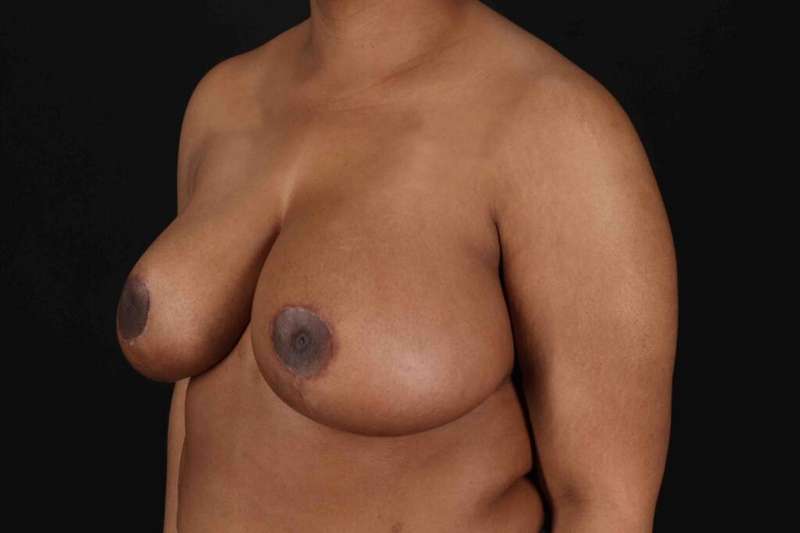 Breast Reduction with Lift Before & After Patient #928