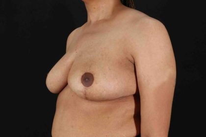 Breast Reduction with Lift Before & After Patient #1005