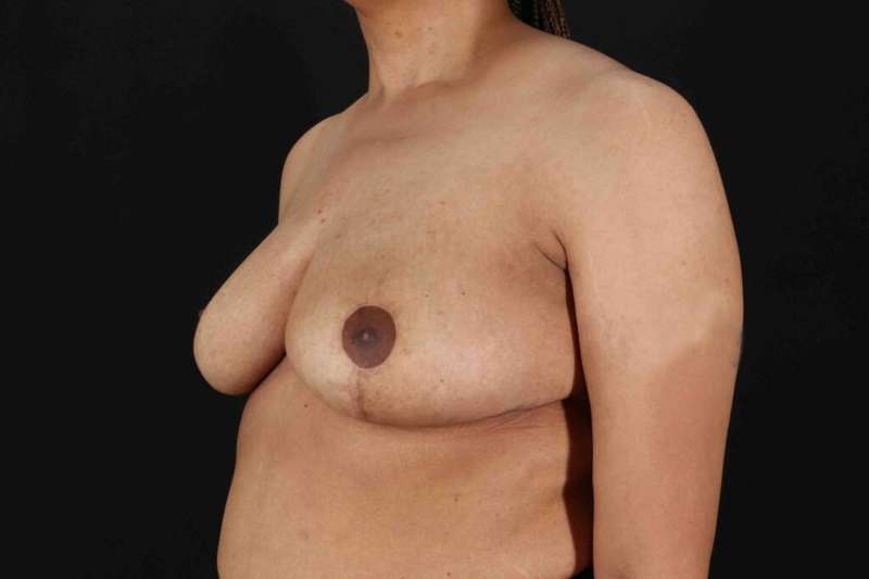 Breast Reduction with Lift Before & After Patient #1005