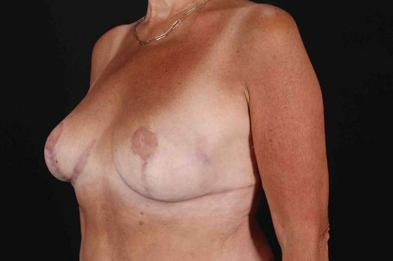 Breast Reduction with Lift Before & After Patient #1016