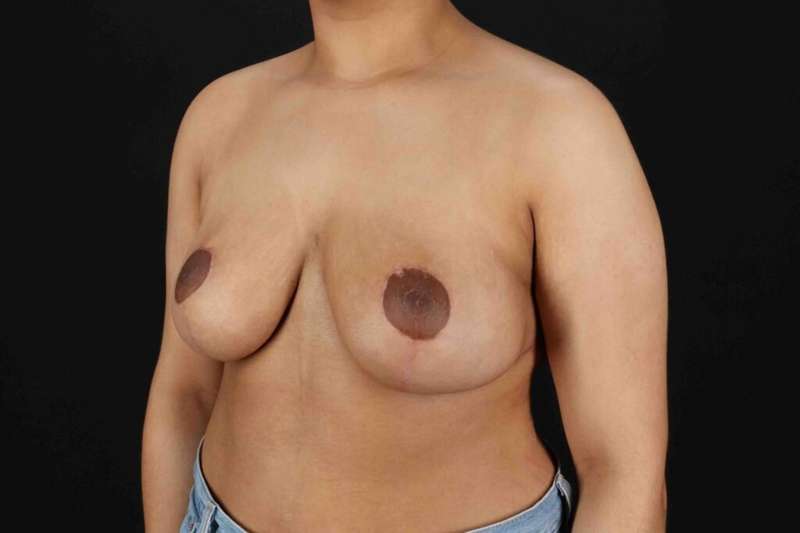 Breast Reduction with Lift Before & After Patient #1027