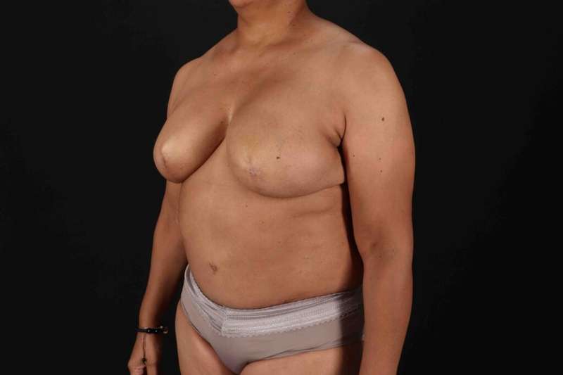 Breast Reconstruction Before & After Patient #1038