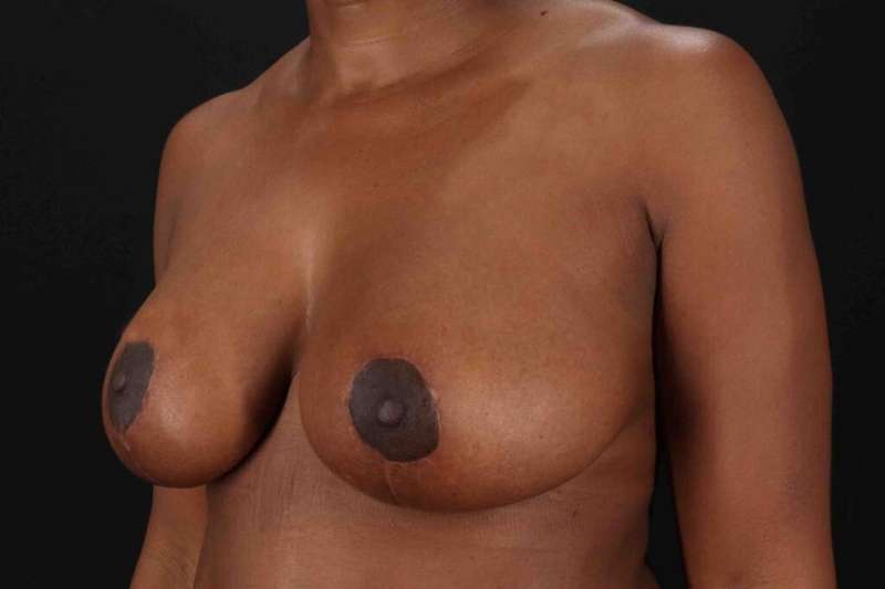 Breast Lift Before & After Patient #1049