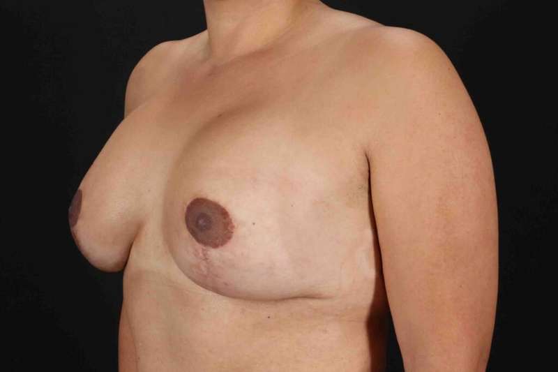 Breast Augmentation with Implants Before & After Patient #1214