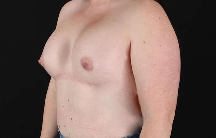 Breast Augmentation with Implants Before & After Patient #1258