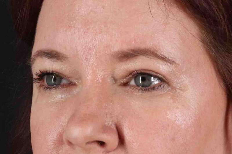 Brow Lift Before & After Patient #1566