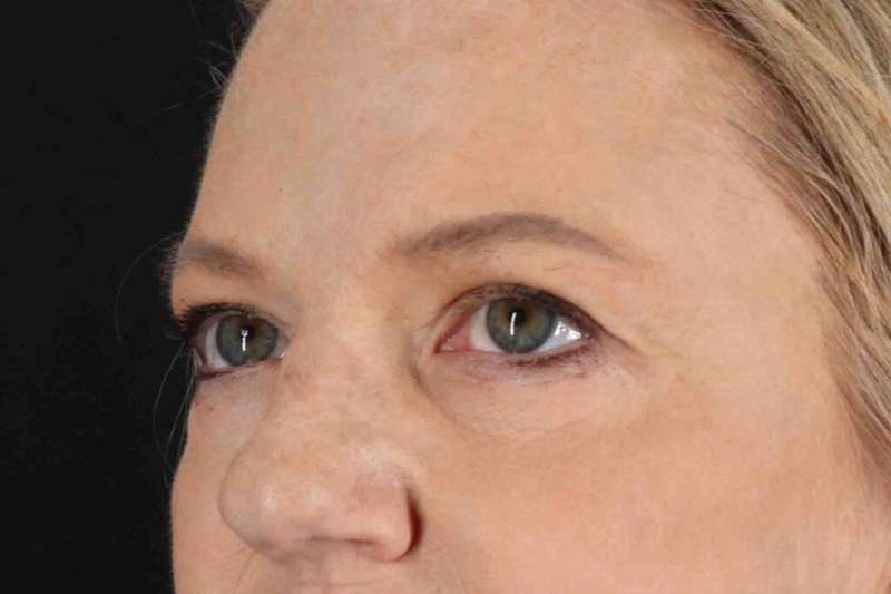 Brow Lift Before & After Patient #1577