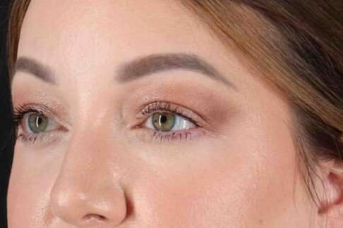 Brow Lift Before & After Patient #1588