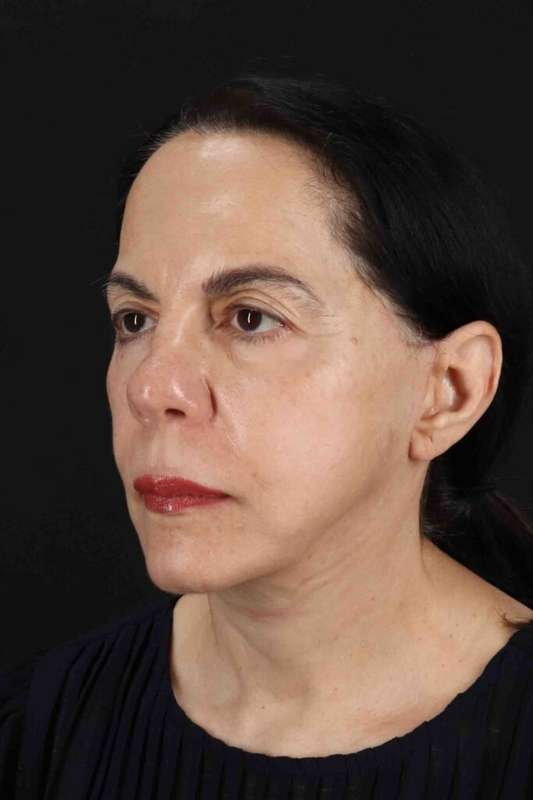 Neck Lift Before & After Patient #1687