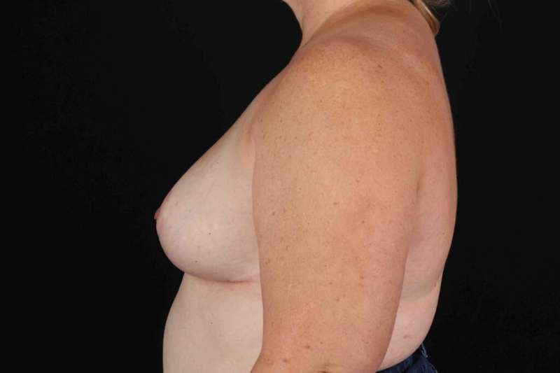 Breast Reduction with Lift Before & After Patient #894