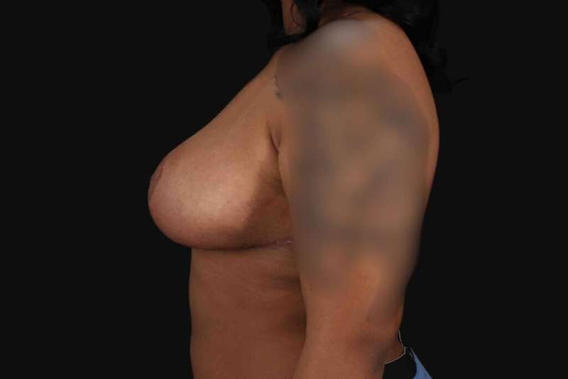 Breast Reduction with Lift Before & After Patient #905