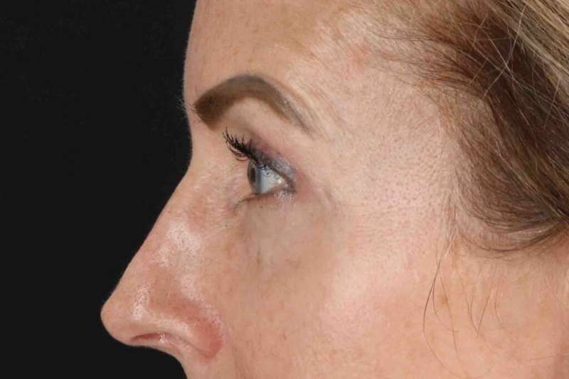 Laser Before & After Patient #2070