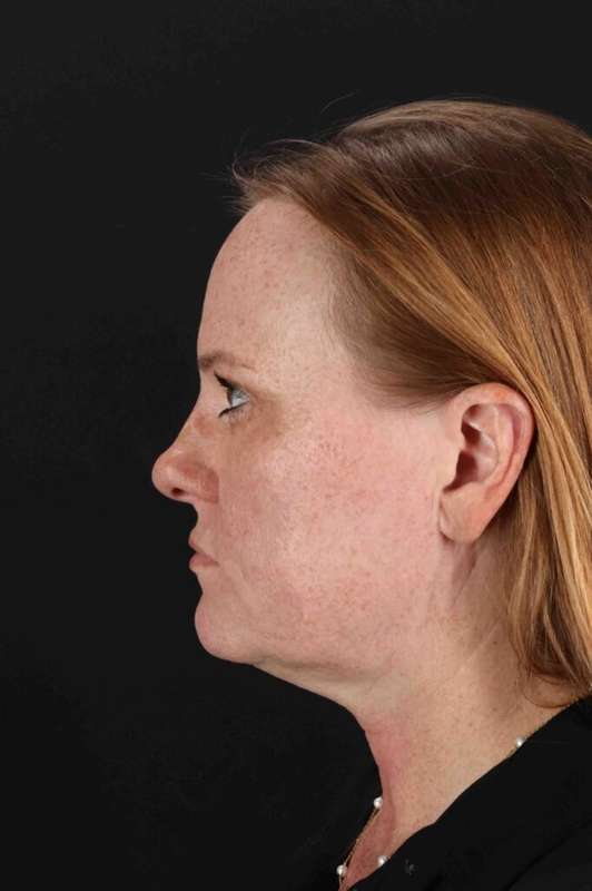 Laser Before & After Patient #2103